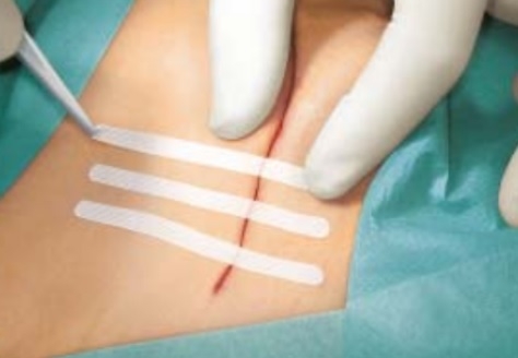Cerotti per sutura cutanea Leukosan strip, sterili